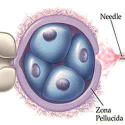 Laser perforation amin'ny rindrin'ny foetus (Assisted hatching) sy ny fampiasana ny Embryo Glue - Best Pediatrician IVF Article